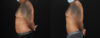 Liposuction case #6116 slider thumbnail