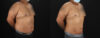 Liposuction case #6116 slider thumbnail