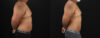 Liposuction case #6116 slider thumbnail