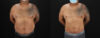 Liposuction case #6116 slider thumbnail