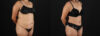 Tummy Tuck case #7461 slider thumbnail