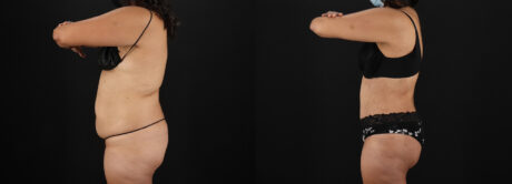 Tummy Tuck case #7461