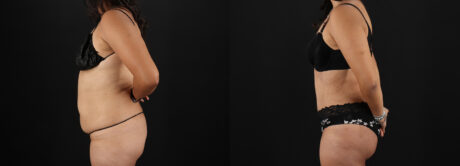 Tummy Tuck case #7461