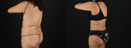 Tummy Tuck case #7461