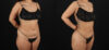 Brazilian Butt Lift case #5270 slider thumbnail