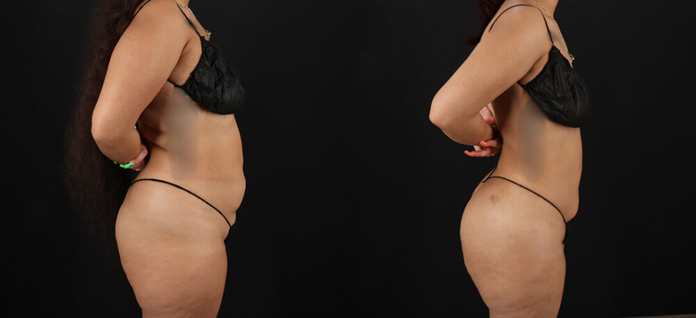 Brazilian Butt Lift case #5270