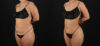 Brazilian Butt Lift case #5270 slider thumbnail