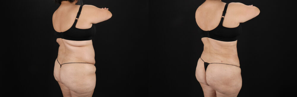 Liposuction case #6115
