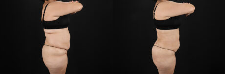 Liposuction case #6115