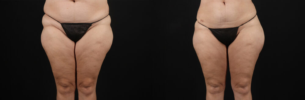 Liposuction case #6115