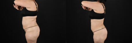 Liposuction case #6115