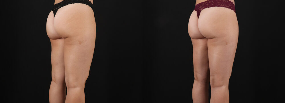 Liposuction case #6114