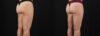 Liposuction case #6114 slider thumbnail
