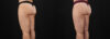 Liposuction case #6114 slider thumbnail