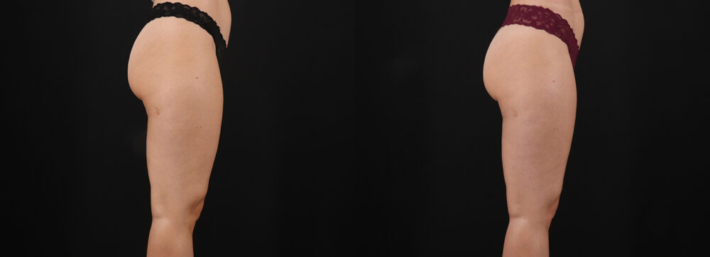 Liposuction case #6114