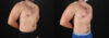 Liposuction case #6113 slider thumbnail