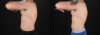 Liposuction case #6113 slider thumbnail