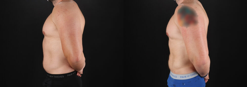 Liposuction case #6113