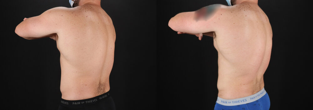 Liposuction case #6113