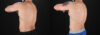 Liposuction case #6113 slider thumbnail