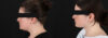 Submental Liposuction case #6954 slider thumbnail