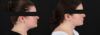 Submental Liposuction case #6954 slider thumbnail