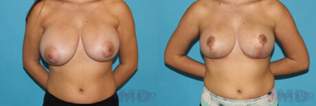 Breast Reduction case #7936