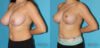 Breast Reduction case #7936 slider thumbnail