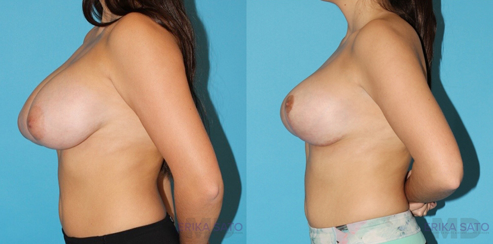 Breast Reduction case #7936