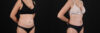 Tummy Tuck case #7463 slider thumbnail
