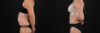 Tummy Tuck case #7463 slider thumbnail