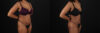 Liposuction case #6118 slider thumbnail