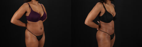 Liposuction case #6118