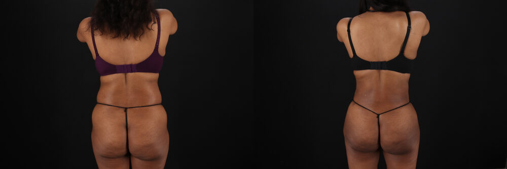 Liposuction case #6118