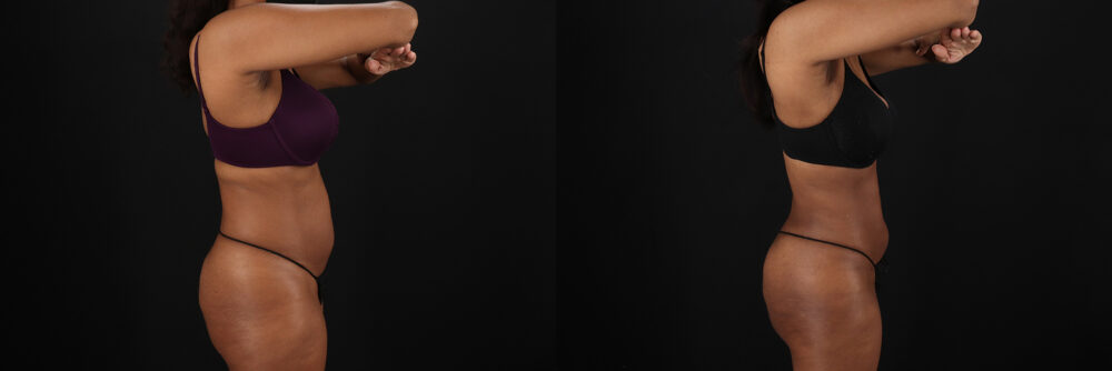 Liposuction case #6118