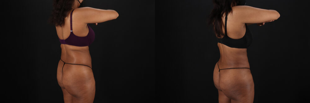 Liposuction case #6118