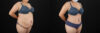 Tummy Tuck case #7464 slider thumbnail