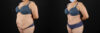 Tummy Tuck case #7464 slider thumbnail