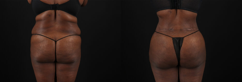 Brazilian Butt Lift case #5271