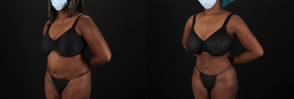 Brazilian Butt Lift case #5271