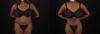 Brazilian Butt Lift case #5271 slider thumbnail