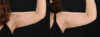 Tummy Tuck case #7465 slider thumbnail