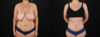 Tummy Tuck case #7465 slider thumbnail
