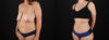 Tummy Tuck case #7465 slider thumbnail