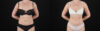Tummy Tuck case #7622 slider thumbnail