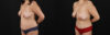 Tummy Tuck case #7626 slider thumbnail