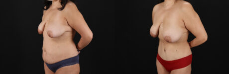 Tummy Tuck case #7626