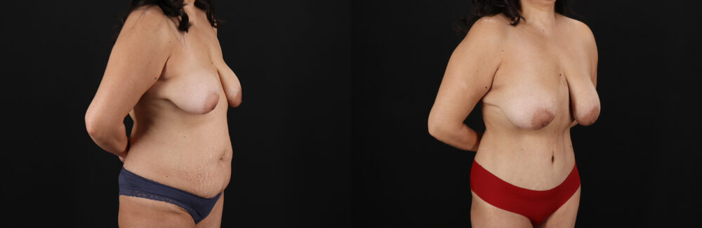 Tummy Tuck case #7626