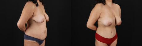 Tummy Tuck case #7626