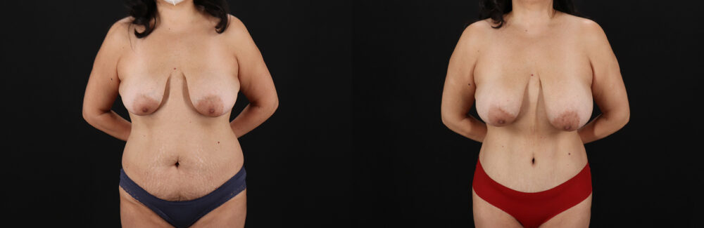 Tummy Tuck case #7626